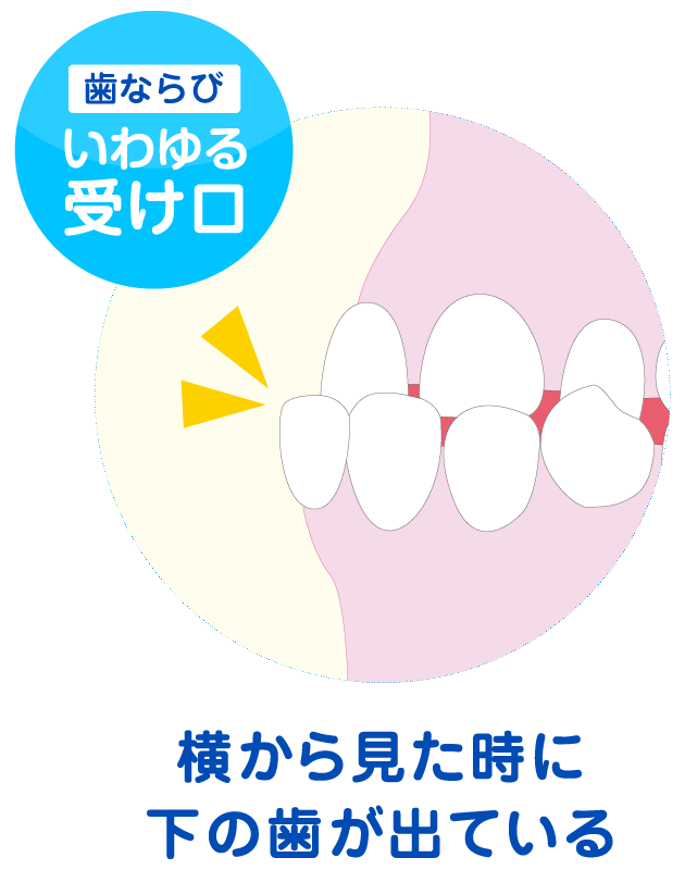 反対咬合のイメージ